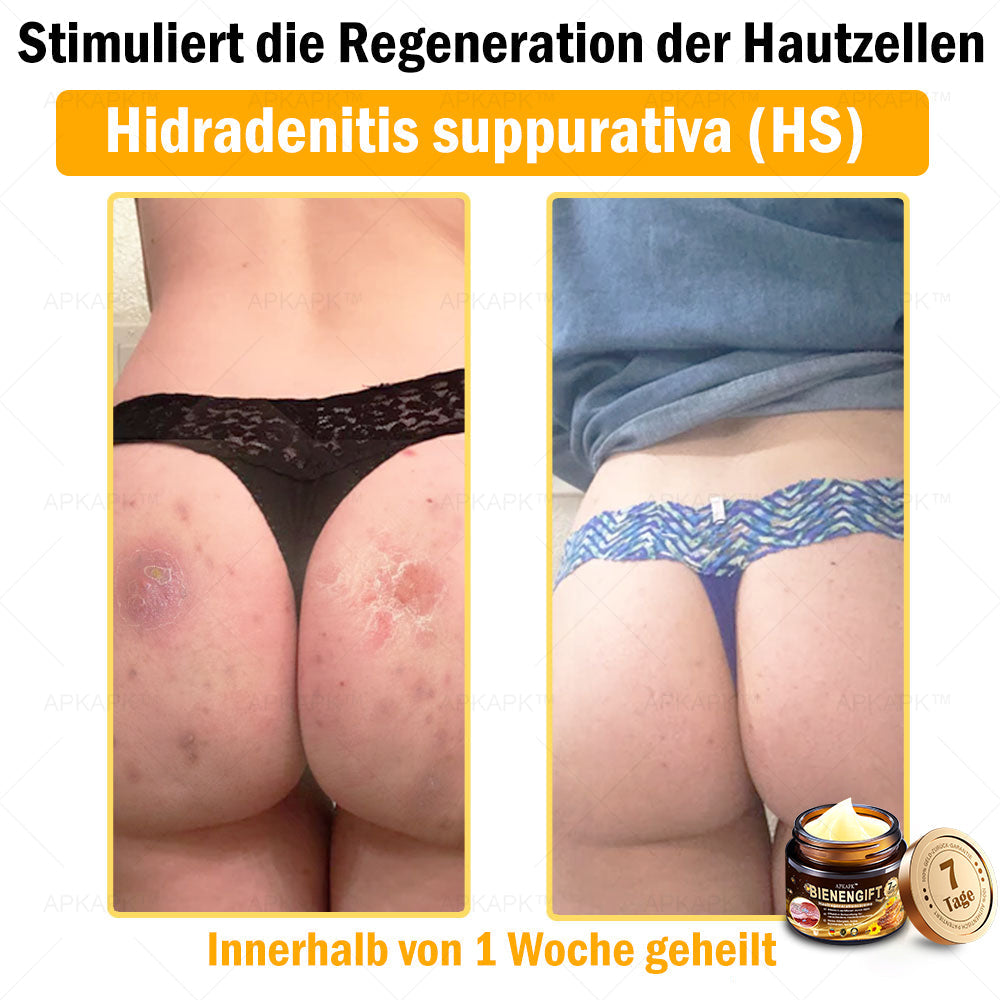 Nur 5 Flaschen! Sichern Sie sich jetzt 50% Rabatt! Verleihen Sie Ihrer Haut in 1 bis 4 Wochen jugendliche Frische. Dieses Angebot kommt erst nächstes Jahr zurück. Schnell zugreifen! 180 Tage Geld-zurück-Garantie!