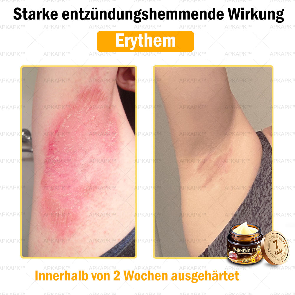 Nur 5 Flaschen! Sichern Sie sich jetzt 50% Rabatt! Verleihen Sie Ihrer Haut in 1 bis 4 Wochen jugendliche Frische. Dieses Angebot kommt erst nächstes Jahr zurück. Schnell zugreifen! 180 Tage Geld-zurück-Garantie!
