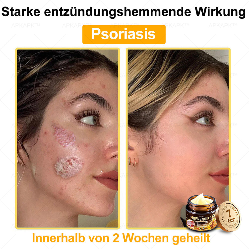 APKAPK™ Krém na regeneráciu pleti s včelím jedom 🧑⚕️Ošetrenie kožných problémov zahŕňa: vekové škvrny, jazvy, bradavice, kožné výrastky, furunkly, akné, ekzémy, psoriázu, akné inversa, vrásky, starnutie pleti a ďalšie.🔥